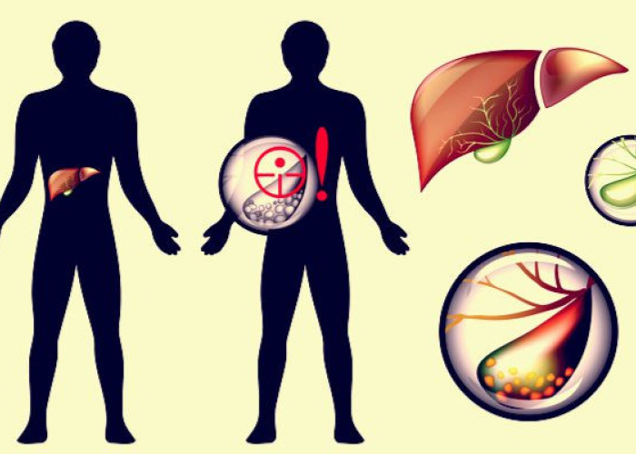 ΠΕΤΡΕΣ ΣΤΗN ΧΟΛΗ: ΣΥΜΠΤΩΜΑΤΑ, ΑΝΤΙΜΕΤΩΠΙΣΗ ΚΑΙ ΠΡΟΛΗΨΗ!