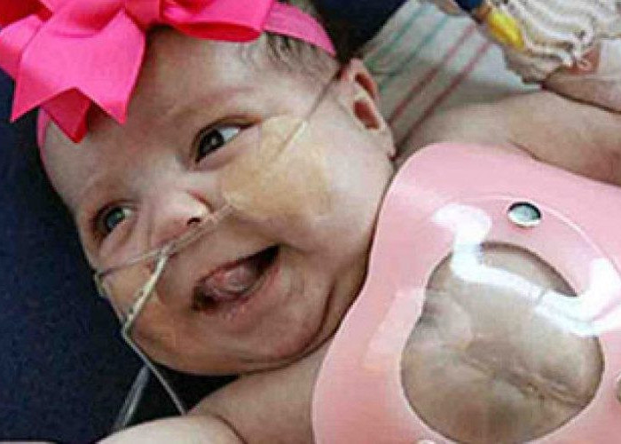 Το μωράκι που γεννήθηκε με την καρδιά έξω από το σώμα του τα κατάφερε και επιστρέφει στο σπίτι της!