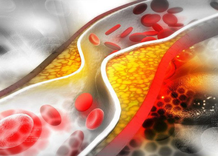 ΣΤΕΝΩΣΗ ΑΡΤΗΡΙΩΝ: TI NA TΡΩΤΕ ΚΑΙ ΤΙ ΝΑ ΑΠΟΦΥΓΕΤΕ!