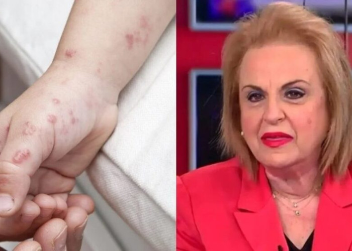 «Ο ιός θα εξαπλωθεί καλοκαίρι»: Σuvαγεpμός για την Ευλογιά των πιθήκων – Τι προκαλεί και πώς κολλάει