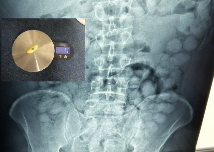 Συνελήφθη Βραζιλιάνος στο «Ελ. Βενιζέλος» για διακίνηση ναρκωτικών – Είχε καταπιεί 100 «αυγά» κοκαΐνης