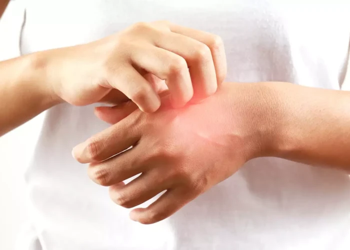 Τι είναι το αλλεργικό σοκ από το οποίο πέθανε ο 46χρονος στο Ναύπλιο: Πότε ένα τσίμπημα γίνεται απειλητικό για τη ζωή