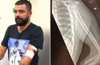 Ο πρώτος άνθρωπος που θα έχει 2 ρομποτικά χέρια και θα τα χειρίζεται με το μυαλό του!