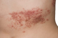 EΡΠΗΣ ΖΩΣΤΗΡΑΣ:TI ΠΡΕΠΕΙ ΝΑ ΚΑΝΕΤΕ ΣΤΗΝ ΠΕΡΙΠΤΩΣΗ ΠΟΥ ΕΚΔΗΛΩΣΕΤΕ ΤΑ ΣΥΜΠΤΩΜΑΤΑ!