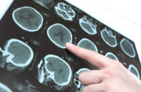 ΝΟΣΟΣ ΚΙΝΗΤΙΚΟΥ ΝΕΥΡΩΝΑ: ΜΕΓΑΛΗ ΠΡΟΣΟΧΗ ΑΝ ΝΙΩΘΕΤΕ ΑΔΥΝΑΜΙΑ ΣΤΙΣ ΑΡΘΡΩΣΕΙΣ!