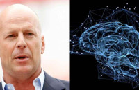 Τι είναι η μετωποκροταφική άνοια με την οποία διαγνώστηκε ο Μπρους Γουίλις