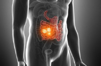 Καρκίνος εντέρου: Αυτή είναι η τροφή που σκοτώνει το 75% των όγκων σύμφωνα με νέα έρευνα