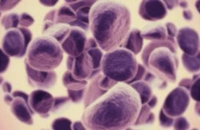 Καινοτόμος μέθοδος για απεικόνιση, διάγνωση και θεραπεία καρκίνου