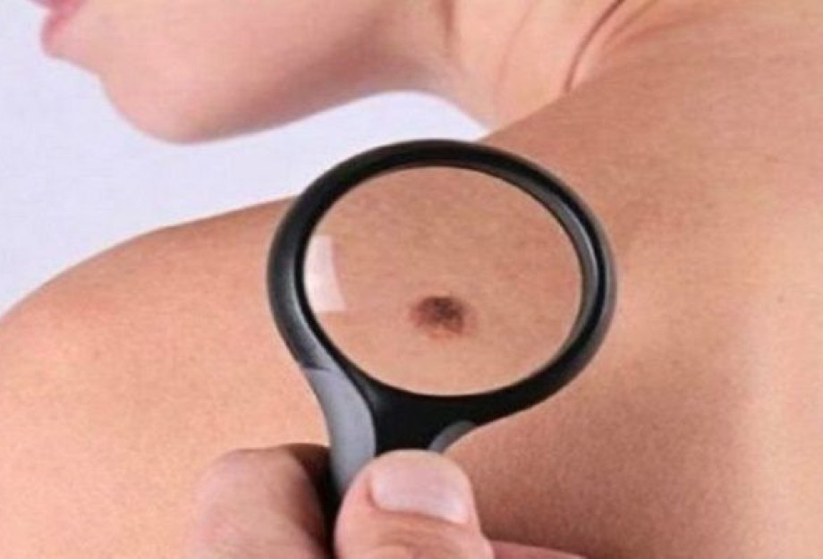 ΣΑΣ «ΤΡΩΝΕ» ΟΙ ΕΛΙΕΣ ΣΤΟ ΔΕΡΜΑ ΣΑΣ; ΔΕΙΤΕ ΠΟΤΕ Η ΦΑΓΟΥΡΑ ΕΙΝΑΙ ΚΑΡΚΙΝΟΣ! ΣΑΣ «ΤΡΩΝΕ» ΟΙ ΕΛΙΕΣ ΣΤΟ ΔΕΡΜΑ ΣΑΣ; ΔΕΙΤΕ ΠΟΤΕ Η ΦΑΓΟΥΡΑ ΕΙΝΑΙ ΚΑΡΚΙΝΟΣ!