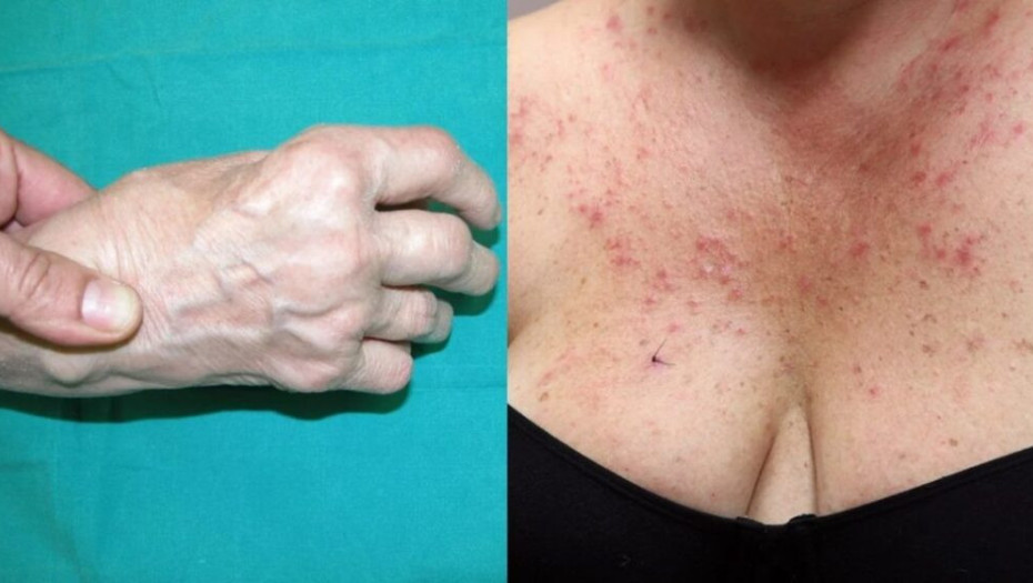 Αuτά είναι τα 5 αυτοάνοσα νοσήματα που «χτυπάνε» τις γυναίκες: Τα ύπουλα συμπτώματα – Πότε να πάτε στον γιατρό