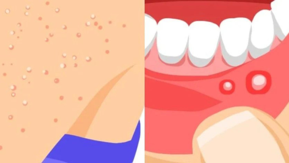 9 ύπουλα συμπτώματα που “μαρτυρούν” πως έχετε δυσανεξία στη γλουτένη και δεν πρέπει να αγνοήσετε