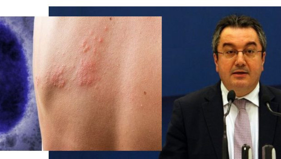 Μόσιαλος: Τι πρέπει να γνωρίζουμε για τα εμβόλια και τα φάρμακα κατά της ευλογιάς των πιθήκων