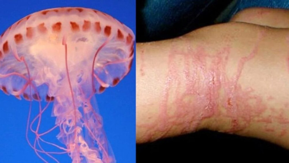 «Σαν να μου έριξαν βιτριόλι»: Η Ευαγγελία τσιμπήθηκε από Μωβ Μέδουσα και περιγράφει τον Eφιάλτn που έζησε