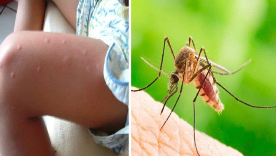 Τα κουνούπια έλκονται περισσότερο από κάποιους ανθρώπους και υπάρχει λόγος – Αποκαλυπτική έρευνα