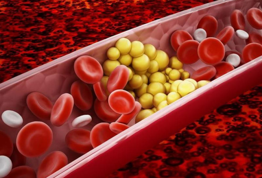 Το πρώτο βήμα για χαμηλότερη χοληστερίνη: Τι προτείνουν οι καρδιολόγοι