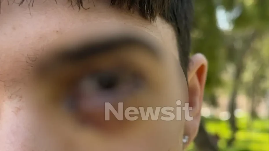 Ξυλοδαρμός στα Ιωάννινα: 17 ράμματα στο μάτι έκανε ο 16χρονος – «Τον χτύπησαν με μίσος, έχει υποστεί βλάβη»