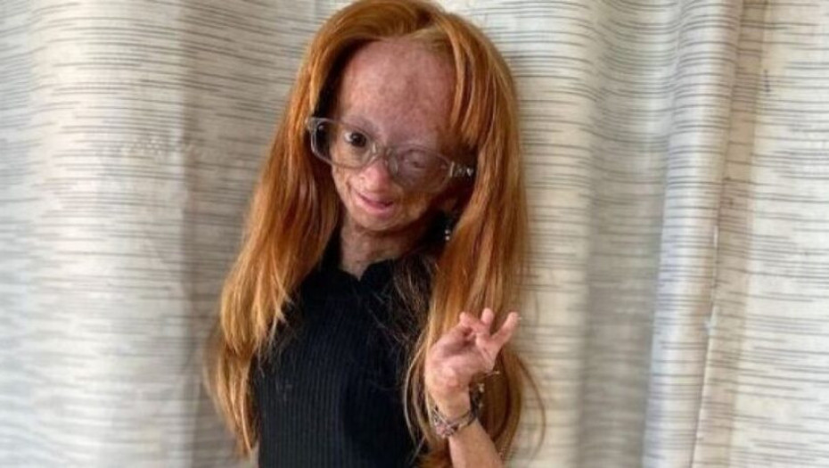 Πέθανε σε ηλικία 15 ετών η σταρ του YouTube που έπασχε από τη νόσο Benjamin Button