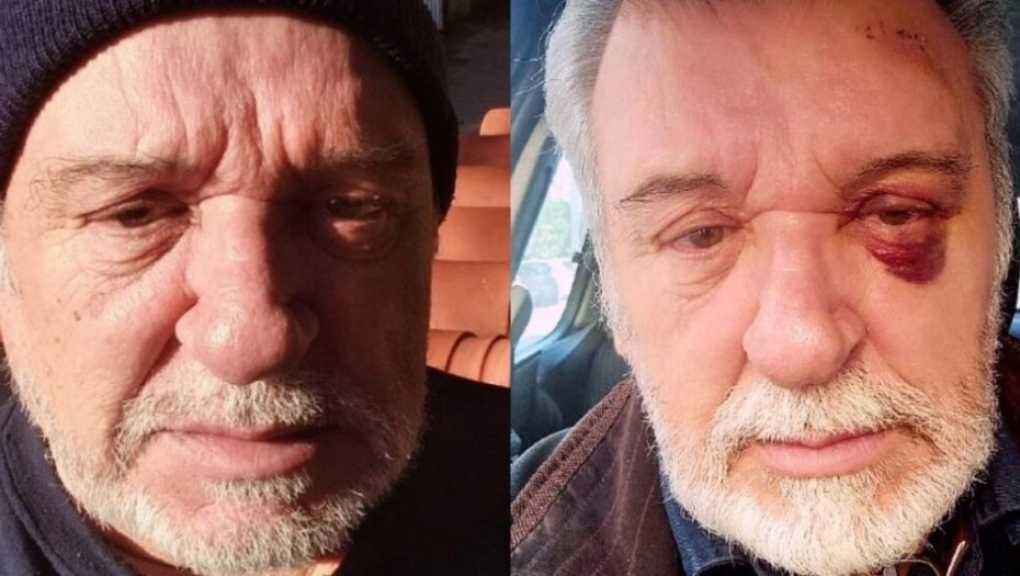 Τάσος Χαλκιάς: Με «μαυρισμένο» μάτι ο ηθοποιός, το μήνυμα όλο νόημα