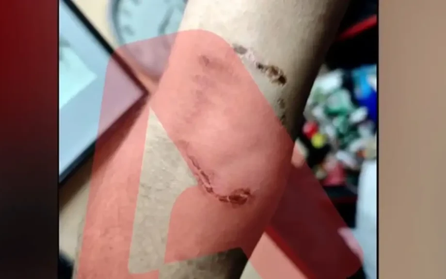 Ομόνοια: Νεαρός έβαλε το πίτμπουλ του να επιτεθεί σε 30χρονο για να τον ληστέψει – «Με έριξε κάτω και το σκυλί με δάγκωνε»