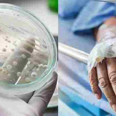 Candida Auris: Τι συμβαίνει με τη διασπορά του μύκητα στα νοσοκομεία – Τι λέει ο Σύψας