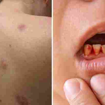 Γιατί οι μισοί Έλληνες κάθε ηλικίας έχουν έλλειψη βιταμίνης D