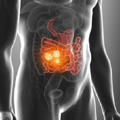 Καρκίνος εντέρου: Αυτή είναι η τροφή που σκοτώνει το 75% των όγκων σύμφωνα με νέα έρευνα