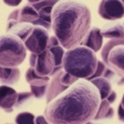 Καινοτόμος μέθοδος για απεικόνιση, διάγνωση και θεραπεία καρκίνου