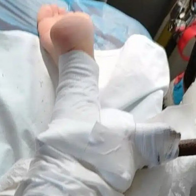 Σοκ στη Χαλκιδική: Ομπρέλα καρφώθηκε στο πόδι 26χρονης – Φυσούσαν θυελλώδεις άνεμοι