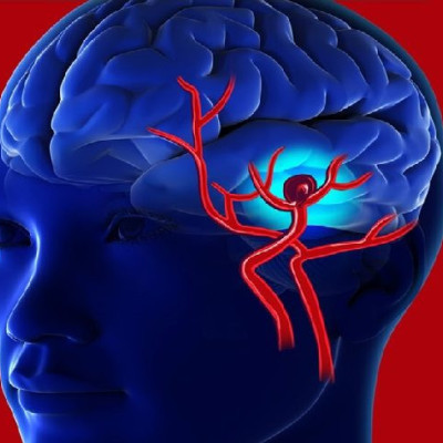 Ανεύρυσμα εγκεφάλου: Μην αγνοήσετε τα αθώα πρώιμα συμπτώματα