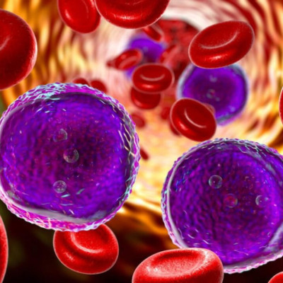 Καρκίνος: Ασθενείς με λευχαιμία θεραπεύτηκαν για πάνω από δέκα χρόνια χάρη στην ανοσοθεραπεία CAR-T